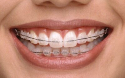 Terapia ortodontica